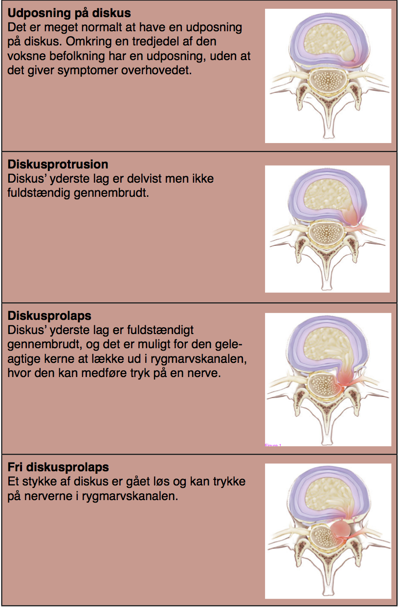 Diskusprolaps Fysioterapi