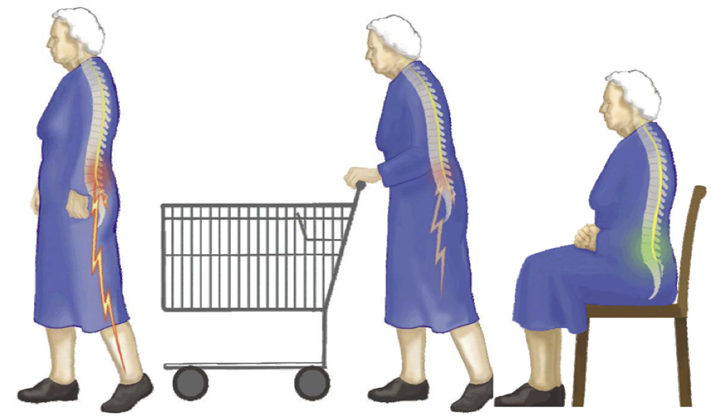 Vejledning til patienter med spinalstenose i lænden