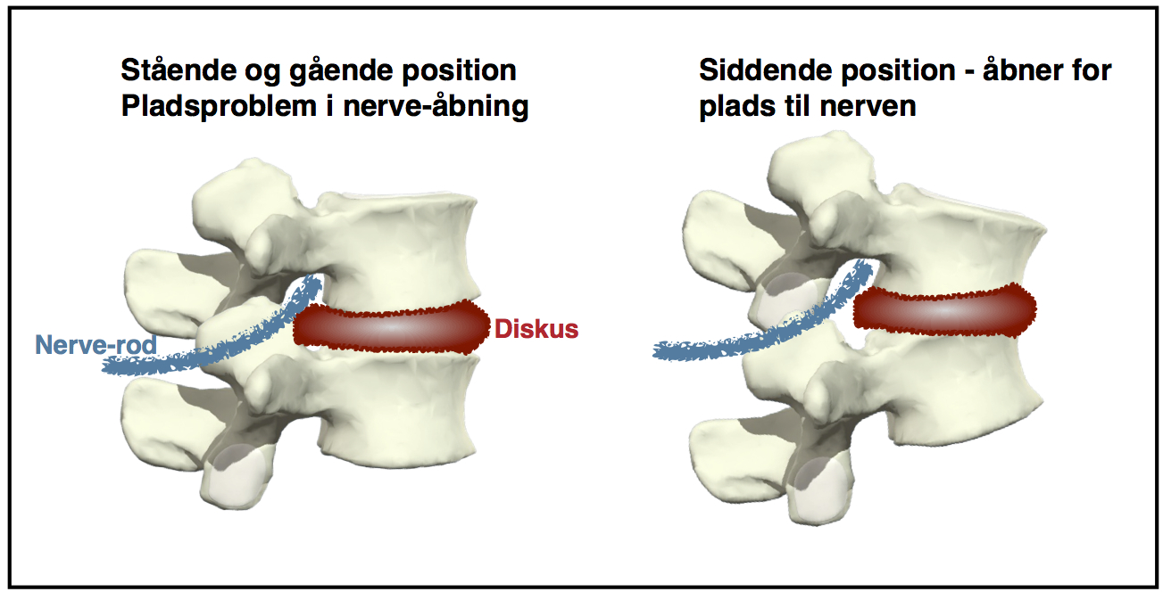 nerve i klemme i lænden nerve i klemme i lænden