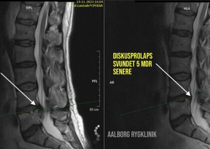 Diskusprolaps – jo større jo bedre
