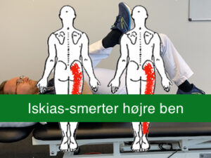 Iskias-smerter i højre ben - smertelindrende øvelsesprogram