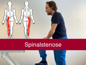 Spinalstenose i lænden - smertelindrende øvelser og genoptræning